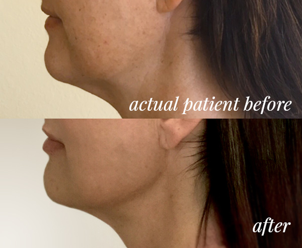 HVME before and after photo - Ultherapy
