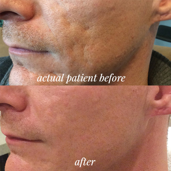 HVME before and after photo - Bellafill