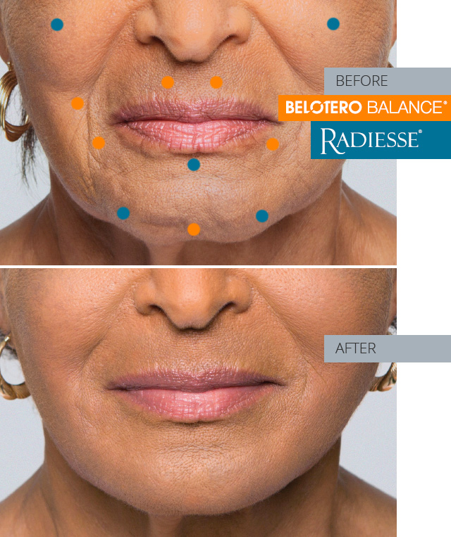 katerine  before and after combo treatment radiesse and belotero balance