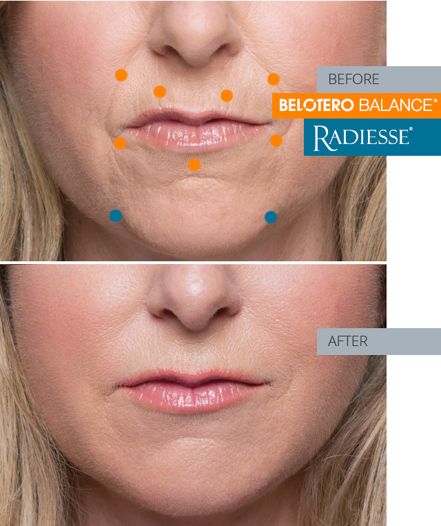 jennifer  before and after combo treatment radiesse and belotero balance