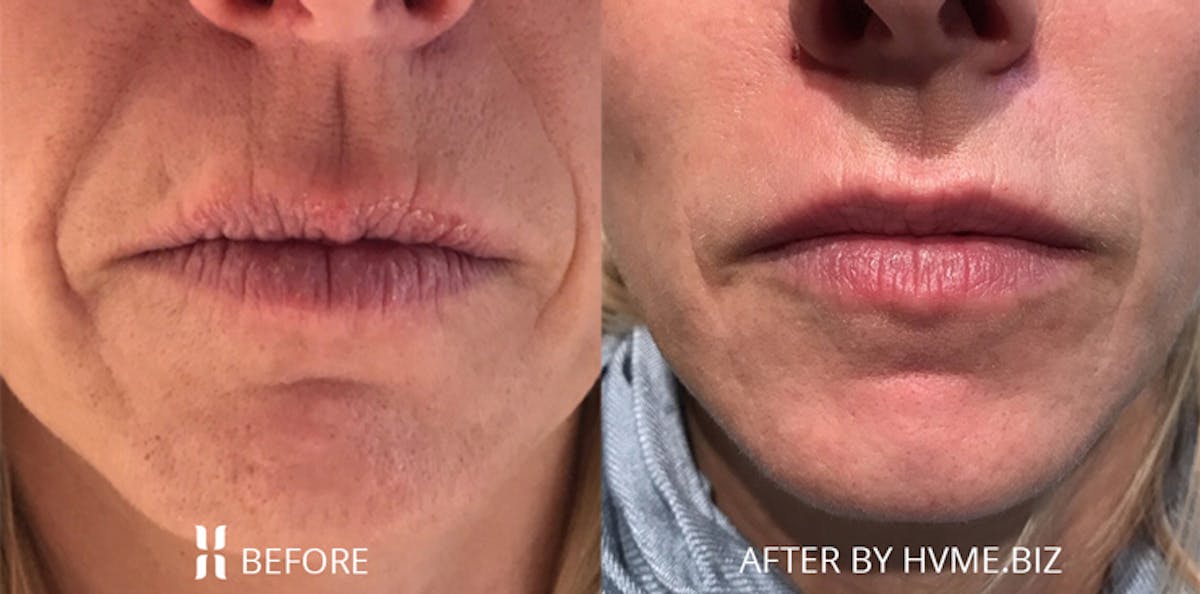 Juvéderm Collection Before & After Gallery - Patient 173884 - Image 1