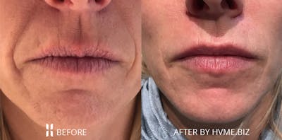 Juvéderm Collection Before & After Gallery - Patient 173884 - Image 1