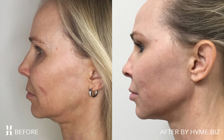 Agnes RF and Scarlet RF before and after photo