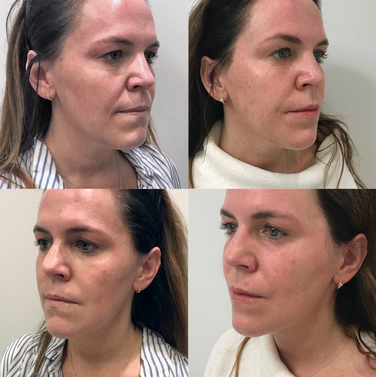 scarlet SRF before and after