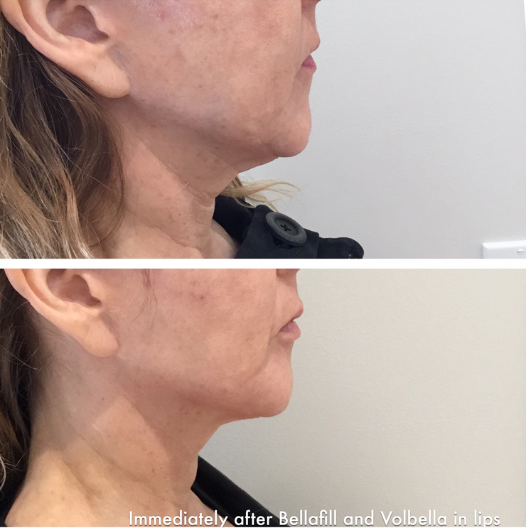 HVME before and after bellafill and volbella