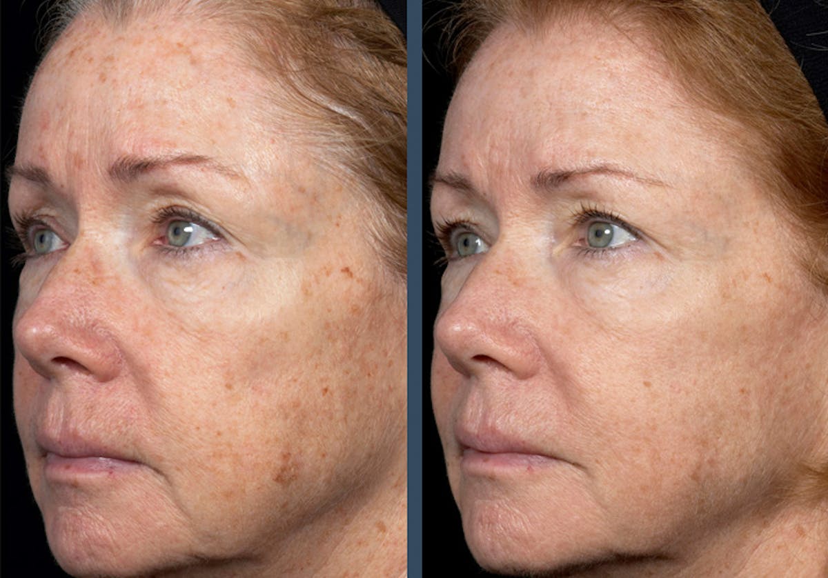 Fraxel DUAL Before & After Gallery - Patient 360805 - Image 1