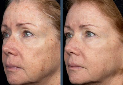 Fraxel DUAL Before & After Gallery - Patient 360805 - Image 1