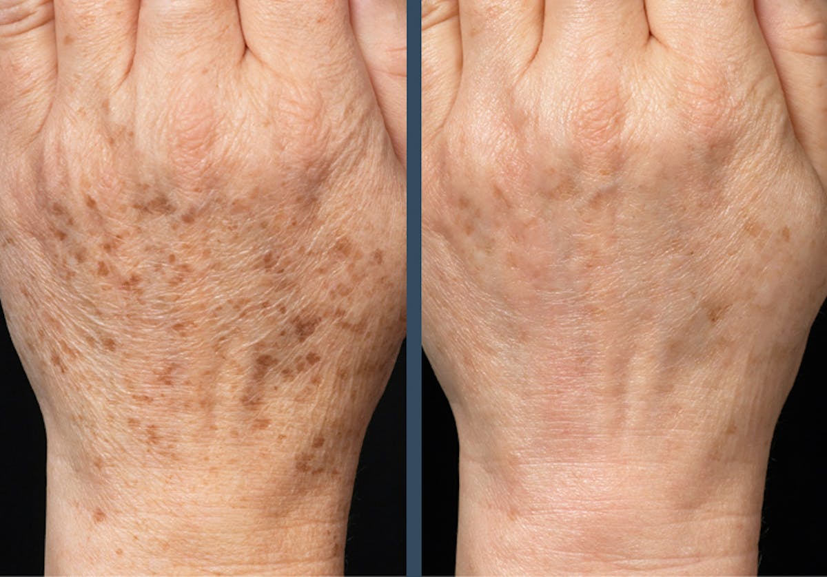 Fraxel DUAL Before & After Gallery - Patient 376794 - Image 1