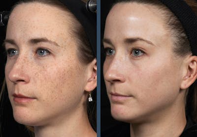 Fraxel DUAL Before & After Gallery - Patient 255760 - Image 1