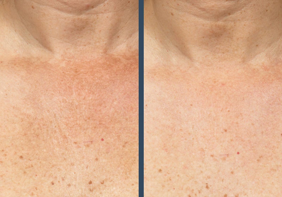 Fraxel DUAL Before & After Gallery - Patient 206153 - Image 1