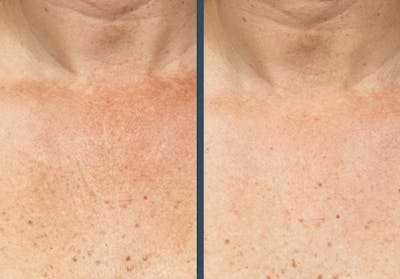 Fraxel DUAL Before & After Gallery - Patient 206153 - Image 1