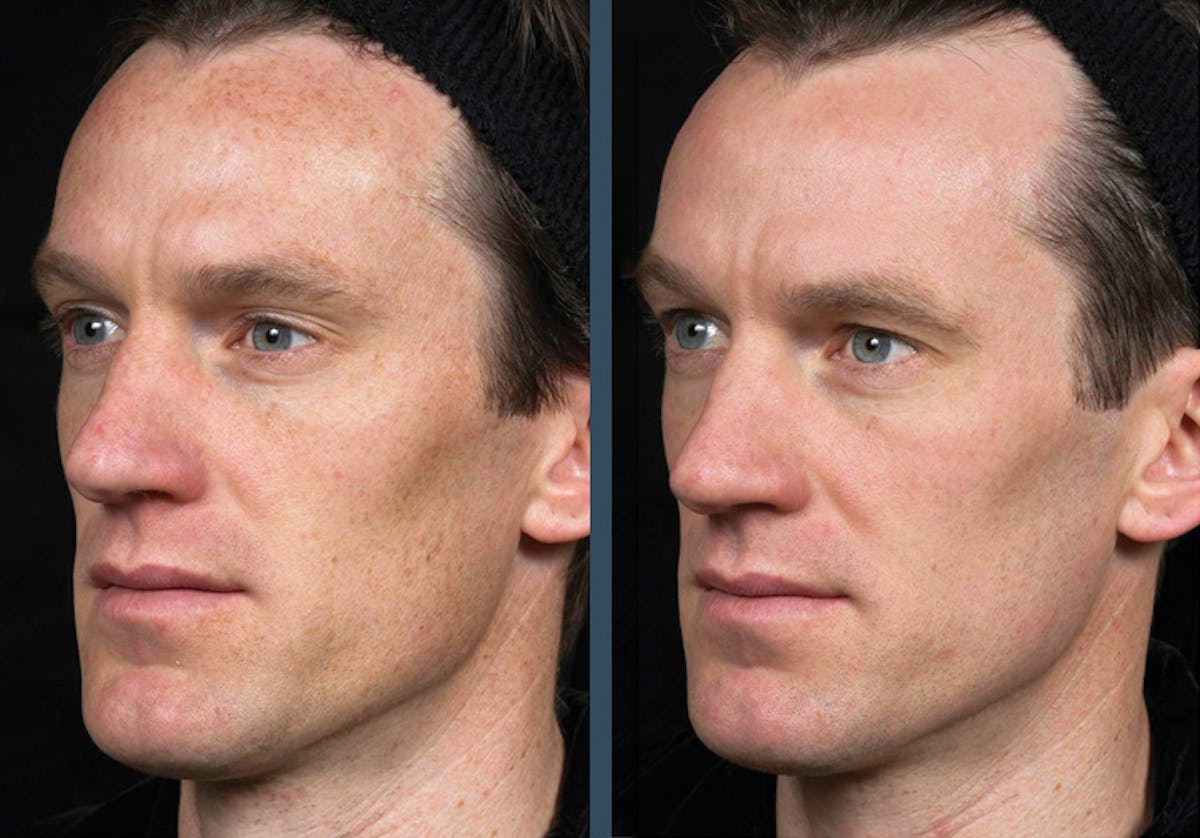 Fraxel DUAL Before & After Gallery - Patient 260236 - Image 1