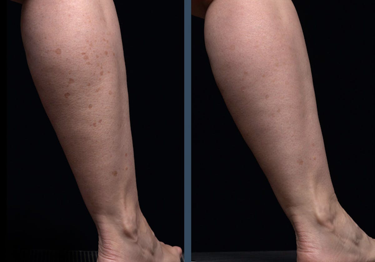 Fraxel DUAL Before & After Gallery - Patient 193400 - Image 1