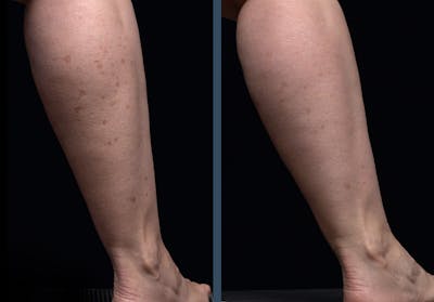 Fraxel DUAL Before & After Gallery - Patient 193400 - Image 1