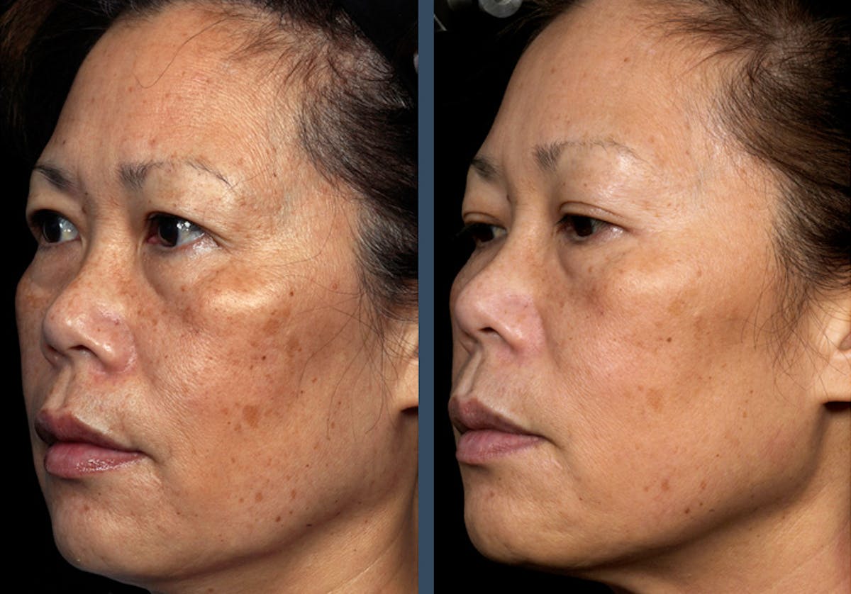 Fraxel DUAL Before & After Gallery - Patient 808001 - Image 1