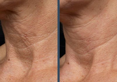 Fraxel DUAL Before & After Gallery - Patient 111447 - Image 1