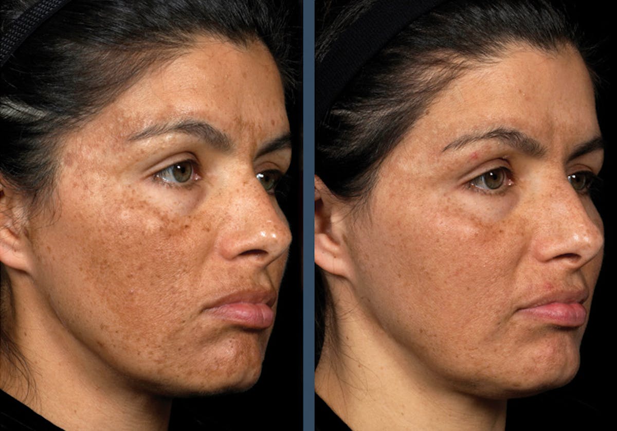 Fraxel DUAL Before & After Gallery - Patient 192264 - Image 1