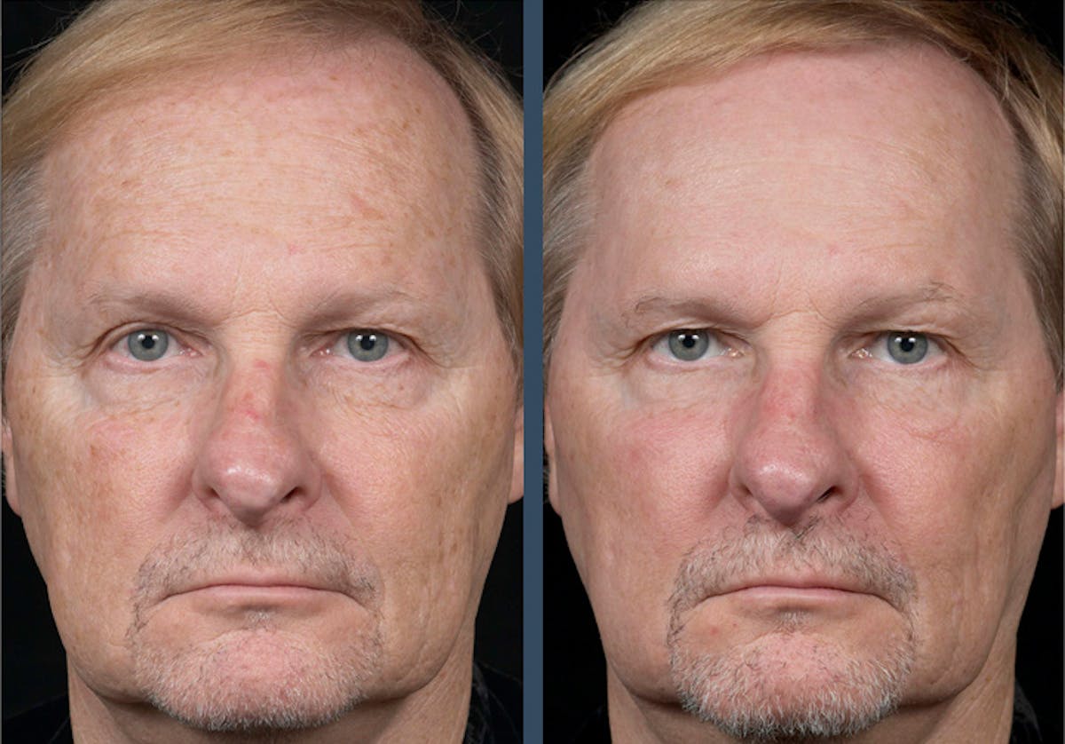 Fraxel DUAL Before & After Gallery - Patient 428882 - Image 1
