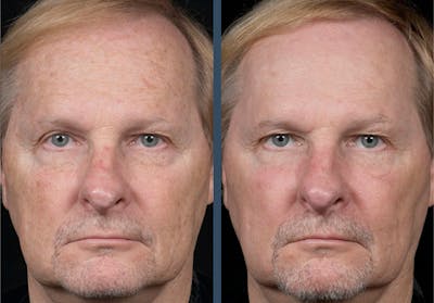 Fraxel DUAL Before & After Gallery - Patient 428882 - Image 1