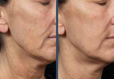 Fraxel DUAL Before & After Gallery - Patient 337888 - Image 1
