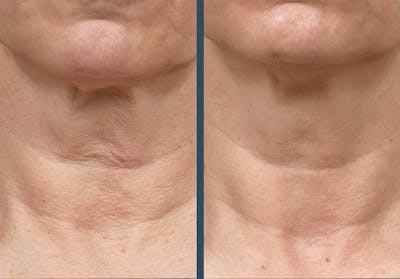 Fraxel DUAL Before & After Gallery - Patient 328079 - Image 1