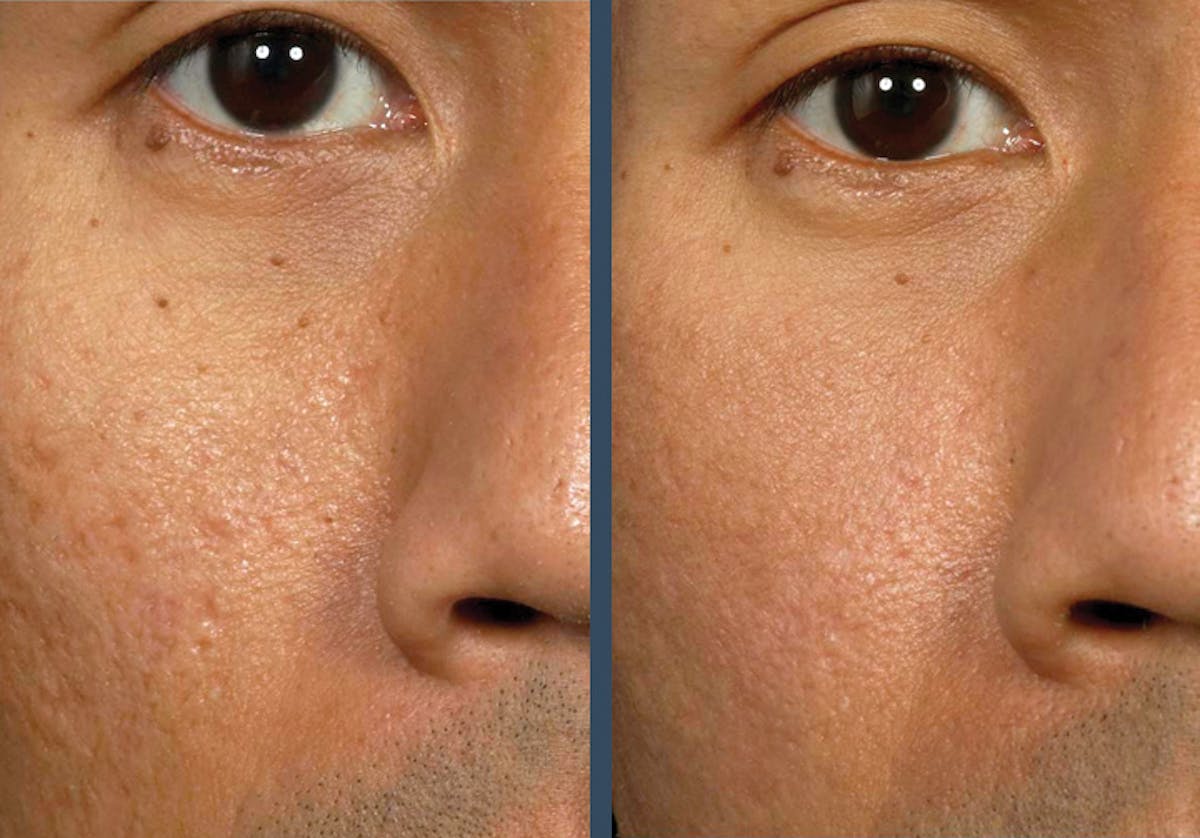 Fraxel DUAL Before & After Gallery - Patient 176227 - Image 1