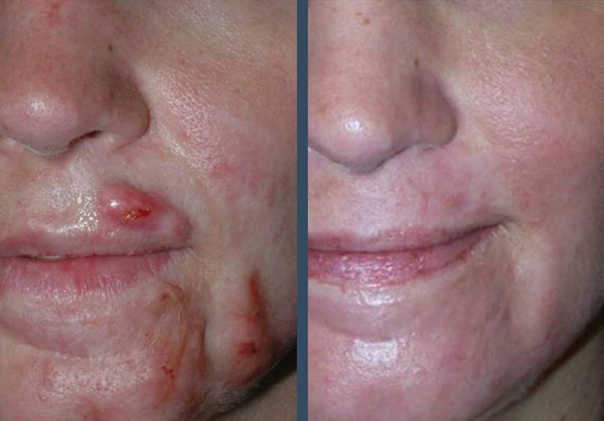 Fraxel DUAL Before & After Gallery - Patient 389097 - Image 1
