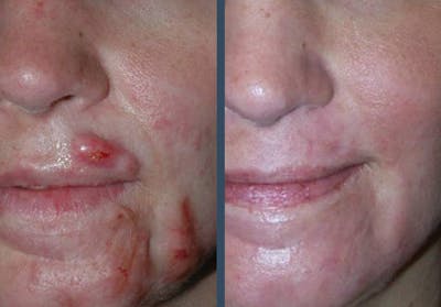 Fraxel DUAL Before & After Gallery - Patient 389097 - Image 1