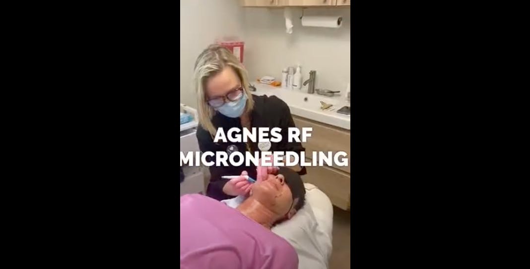 microneedling video
