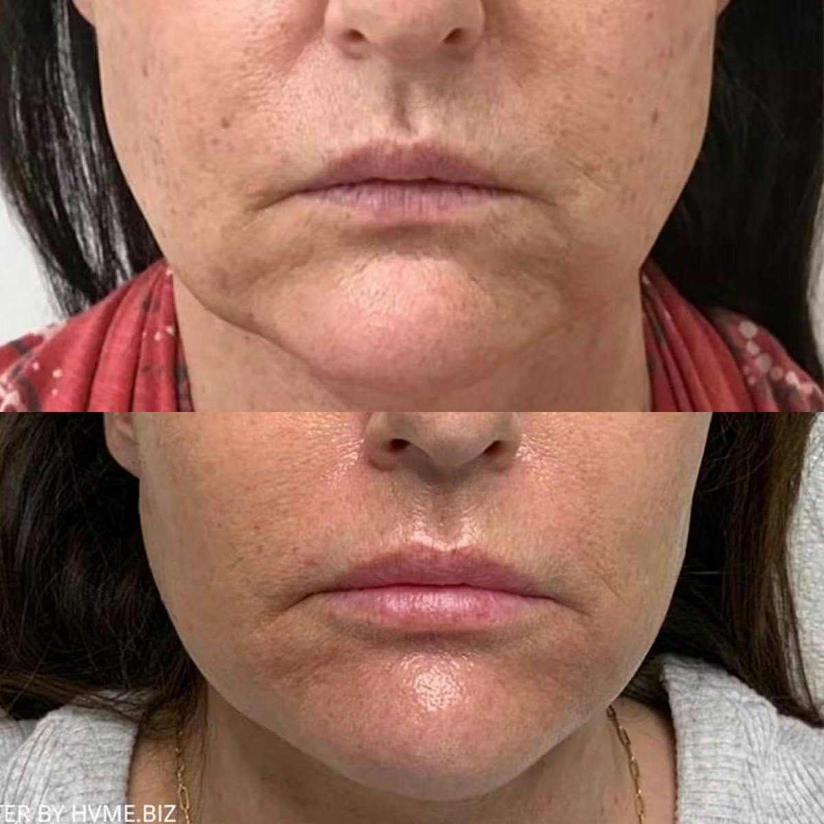 Lip Filler Before & After Gallery - Patient 112233 - Image 1