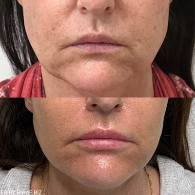 Lip Filler Before & After Gallery - Patient 112233 - Image 1