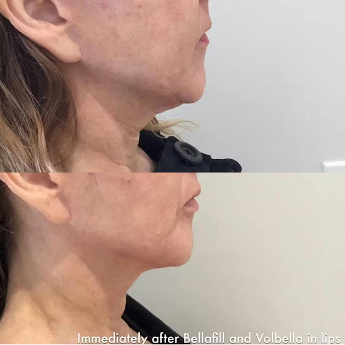 Juvéderm Collection Before & After Gallery - Patient 198858 - Image 1