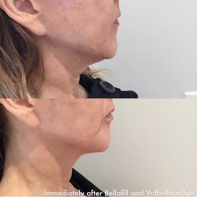 Juvéderm Collection Before & After Gallery - Patient 198858 - Image 1