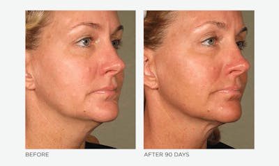 Ultherapy: Tighten + Sculpt Before & After Gallery - Patient 425390 - Image 1