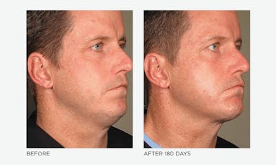 Ultherapy: Tighten + Sculpt Before & After Gallery - Patient 135092 - Image 1