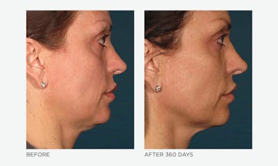 Ultherapy: Tighten + Sculpt Before & After Gallery - Patient 278147 - Image 1