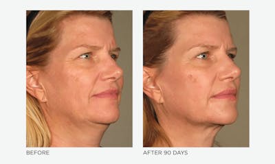 Ultherapy: Tighten + Sculpt Before & After Gallery - Patient 252277 - Image 1