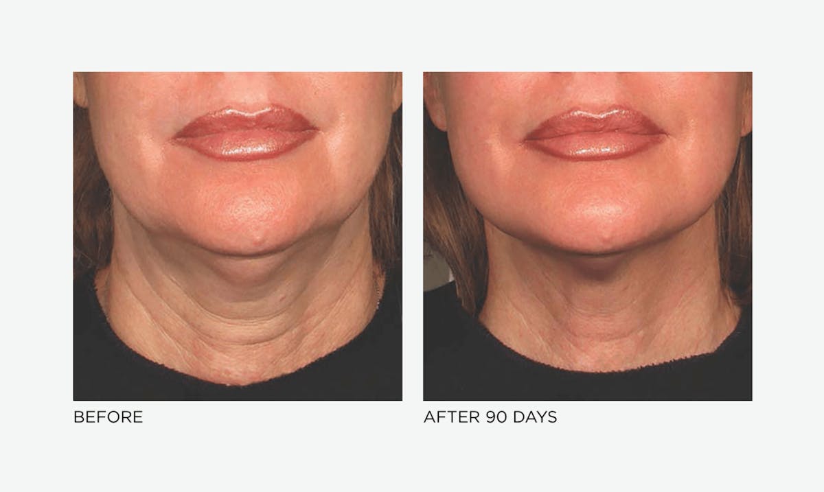 Ultherapy: Tighten + Sculpt Before & After Gallery - Patient 407963 - Image 1