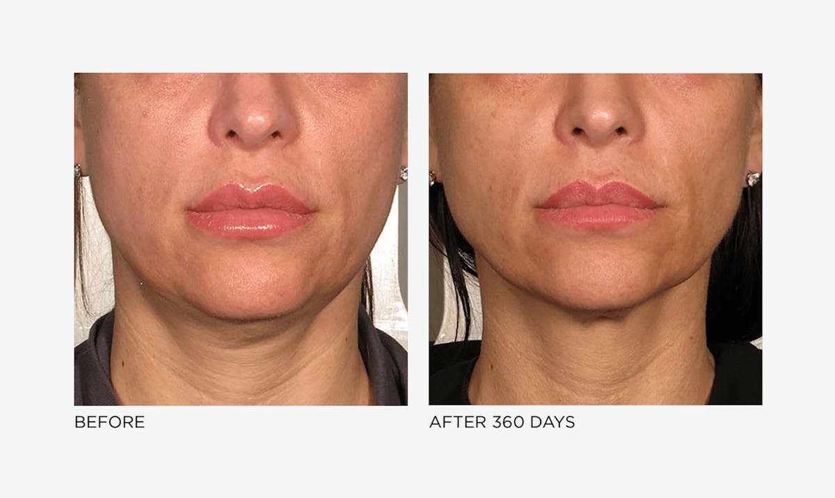 Ultherapy: Tighten + Sculpt Before & After Gallery - Patient 367418 - Image 1