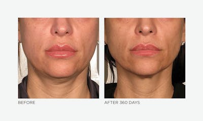 Ultherapy: Tighten + Sculpt Before & After Gallery - Patient 367418 - Image 1