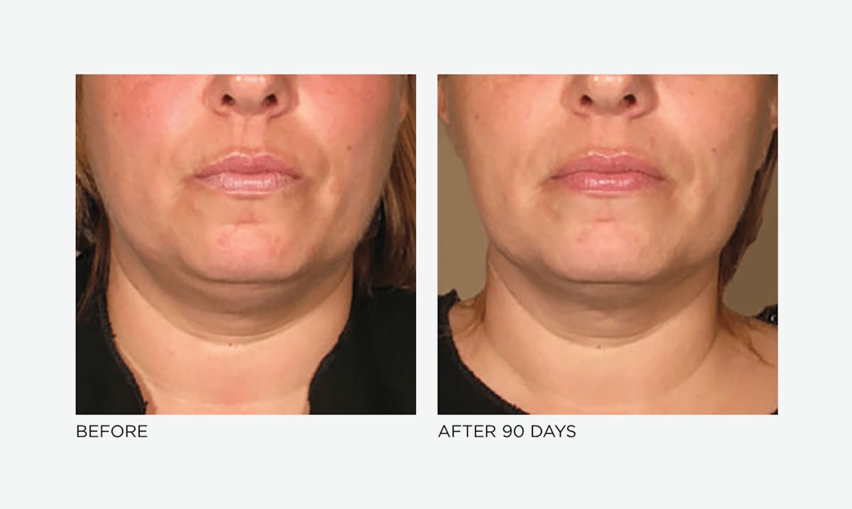 Ultherapy: Tighten + Sculpt Before & After Gallery - Patient 946180 - Image 1