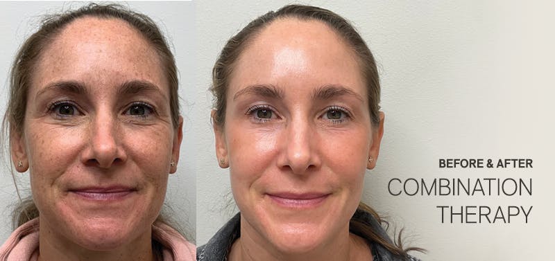Combination therapy before and after
