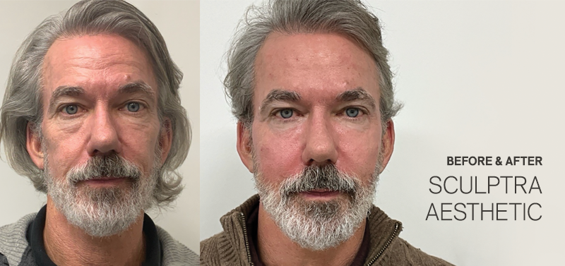 Sculptra before and after