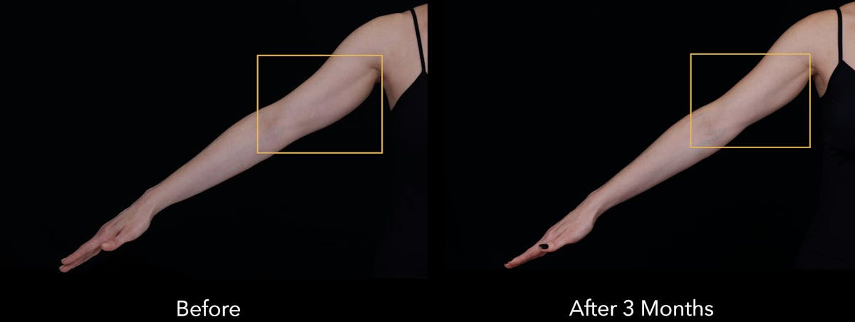 Ultherapy: Tighten + Sculpt Before & After Gallery - Patient 339423 - Image 1