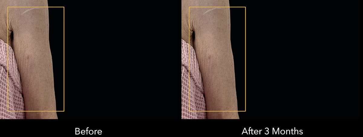 Ultherapy: Tighten + Sculpt Before & After Gallery - Patient 108100 - Image 1