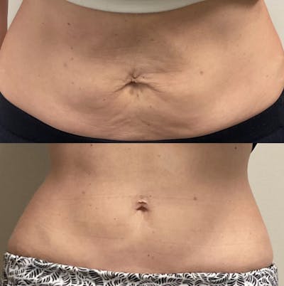 I-Laser Before & After Gallery - Patient 983952 - Image 1
