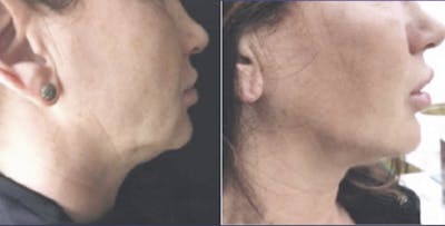 I-Laser Before & After Gallery - Patient 242248 - Image 1