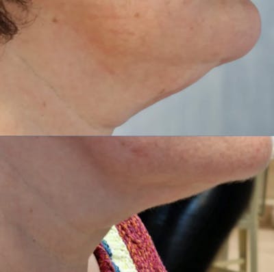 I-Laser Before & After Gallery - Patient 207037 - Image 1