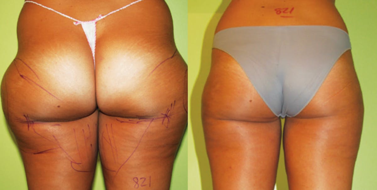 I-Laser Before & After Gallery - Patient 682195 - Image 1