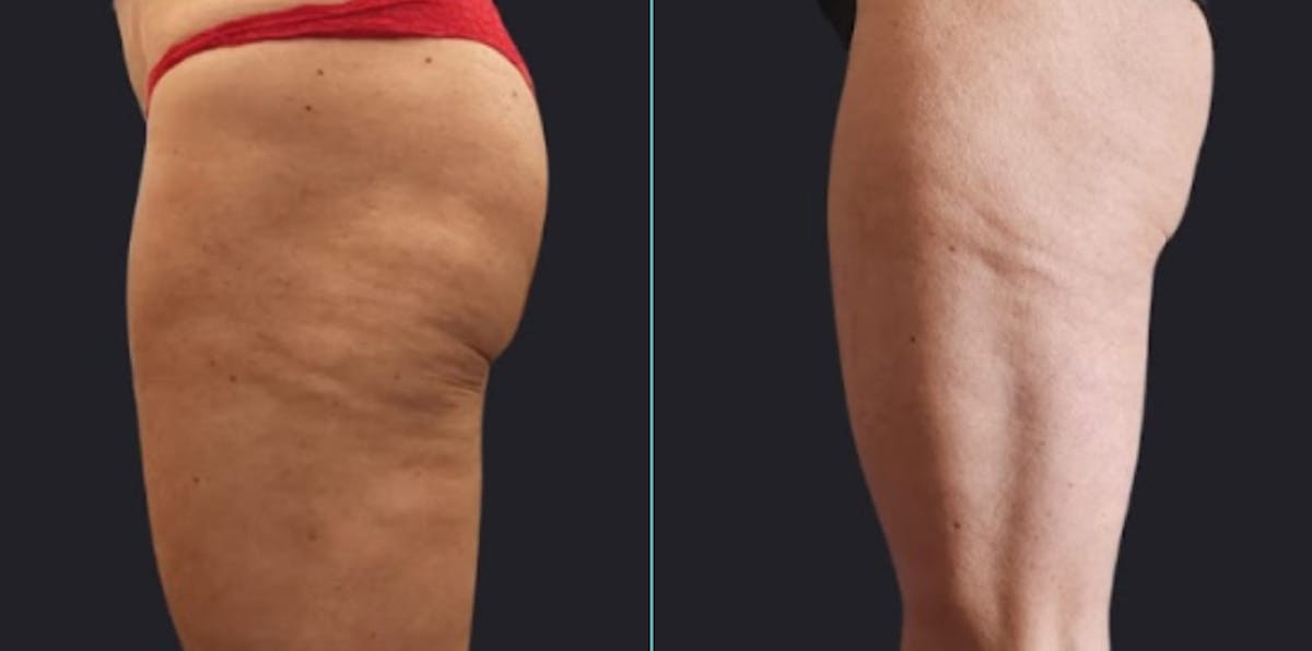 I-Laser Before & After Gallery - Patient 168325 - Image 1